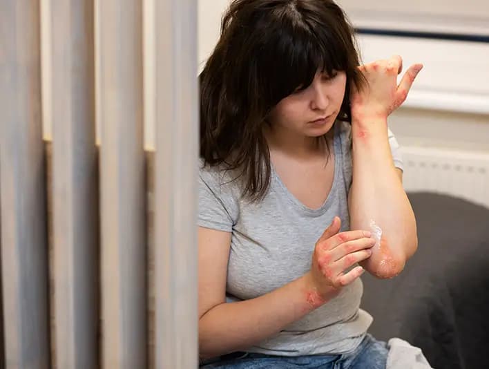 Get Online Treatment for Eczema in Women